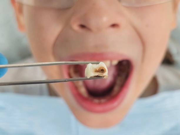 Best Broken or Chipped Tooth Repair in Huntington Bay, NY