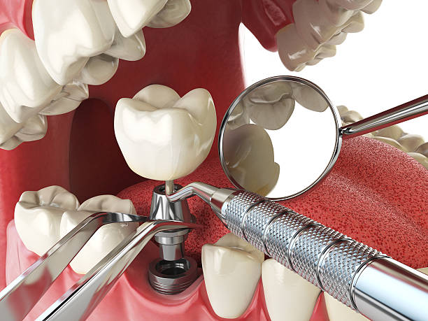 Best Emergency Cosmetic Dentistry (e.g., broken veneers) in Huntington Bay, NY